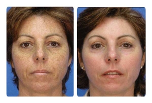 Microdermabrasion-Before-and-After